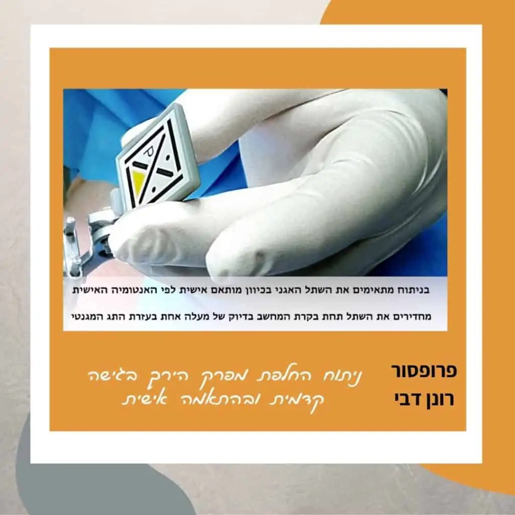 פרופ' רונן דבי, ניתוח החלפת מפרק ירך בשיטה קדמית, בהתאמה אישית.