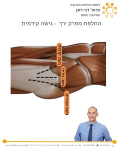 Hip replacement surgery, anterior approach, customized. Prof. Ronen Debi