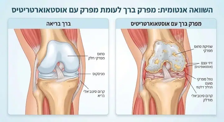 ארטריטיס